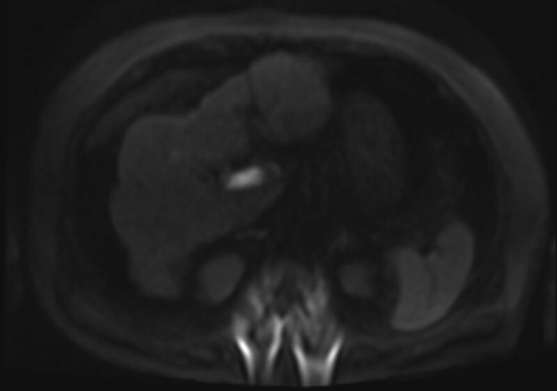 File:Acute portal vein thrombosis (Radiopaedia 73198-83925 Axial DWI 74).jpg