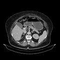 Acute pyelonephritis (Radiopaedia 25657-25837 Axial renal parenchymal phase 27).jpg