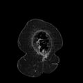 Acute pyelonephritis (Radiopaedia 25657-25837 Coronal renal parenchymal phase 11).jpg