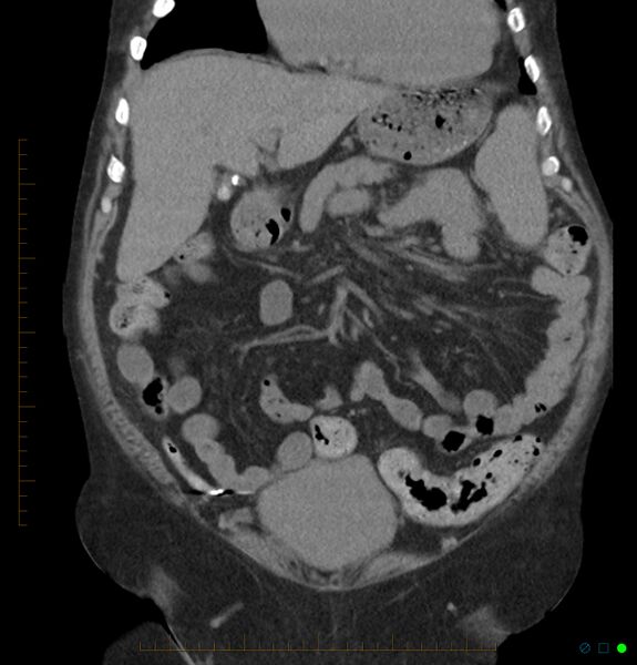 File:Acute renal failure post IV contrast injection- CT findings (Radiopaedia 47815-52557 Coronal non-contrast 13).jpg