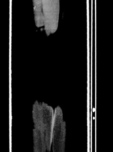 File:Acute small bowel (ileal) volvulus (Radiopaedia 71740-82139 Coronal C+ portal venous phase 115).jpg