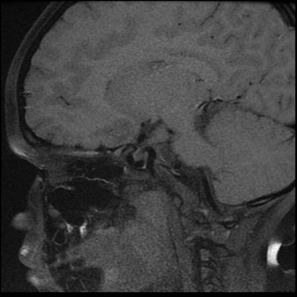 File:Adamantinomatous craniopharyngioma (Radiopaedia 77407-89529 Sagittal T1 fat sat 11).jpg