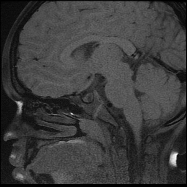 File:Adamantinomatous craniopharyngioma (Radiopaedia 77407-89529 Sagittal T1 fat sat 9).jpg