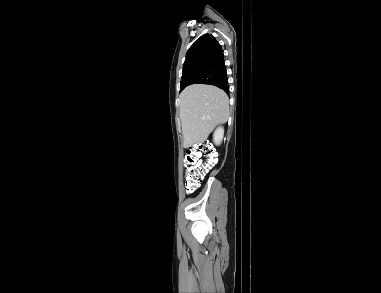 File:Addison disease (Radiopaedia 49318-54412 Sagittal C+ portal venous phase 56).jpg