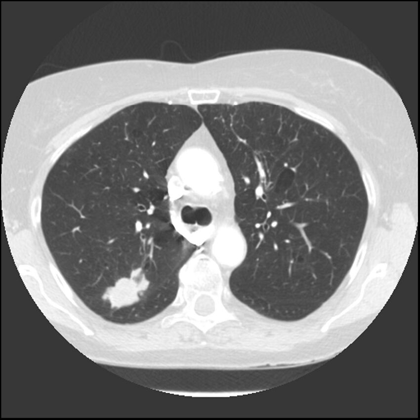 Adenocarcinoma of the lung (Radiopaedia 41015-43755 Axial lung window 41).jpg
