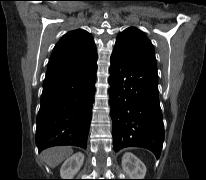 File:Adenocarcinoma of the lung (Radiopaedia 44205-47803 Coronal C+ portal venous phase 73).jpg