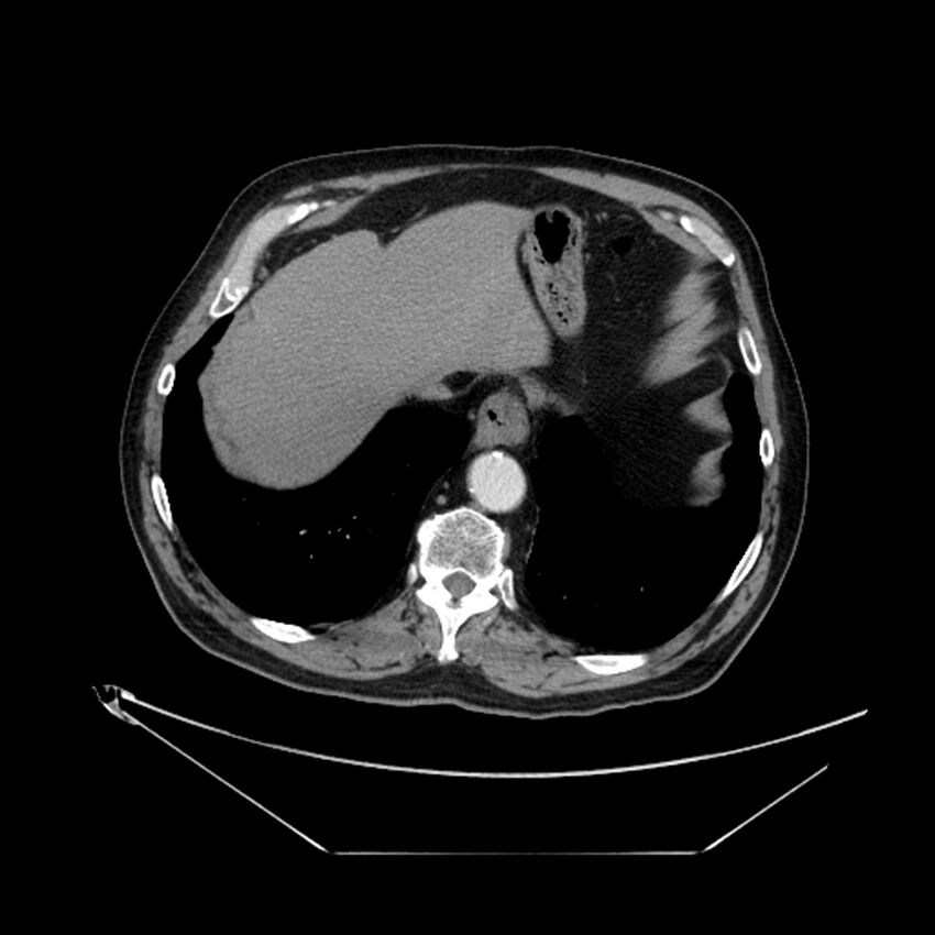 Adenocarcinoma of the lung (Radiopaedia 44876-48759 Axial C+ portal venous phase 70).jpg
