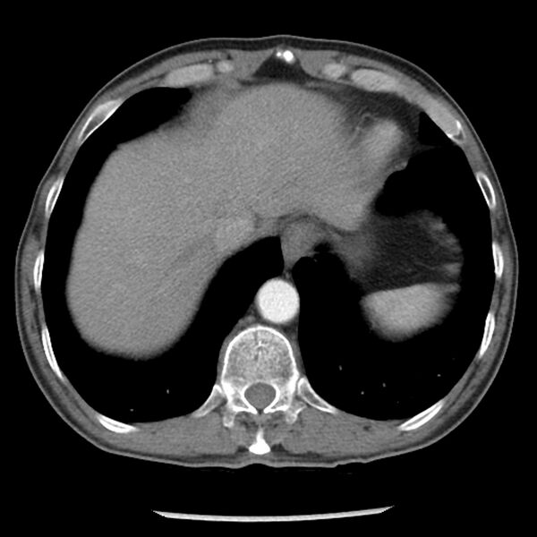 File:Adenocarcinoma of the lung - micropapillary predominant (Radiopaedia 42446-45563 Axial C+ portal venous phase 62).jpg