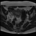Adenoma malignum of the cervix (Radiopaedia 24460-24765 C 6).jpg