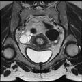 Adenoma malignum of the cervix (Radiopaedia 24460-24765 Coronal T2 12).jpg