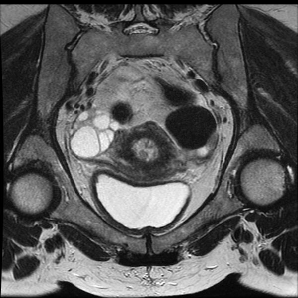 File:Adenoma malignum of the cervix (Radiopaedia 24460-24765 Coronal T2 12).jpg