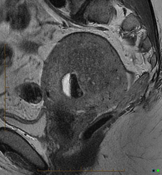 File:Adenomyosis uterus with hematometra (Radiopaedia 45779-50011 Sagittal T2 19).jpg