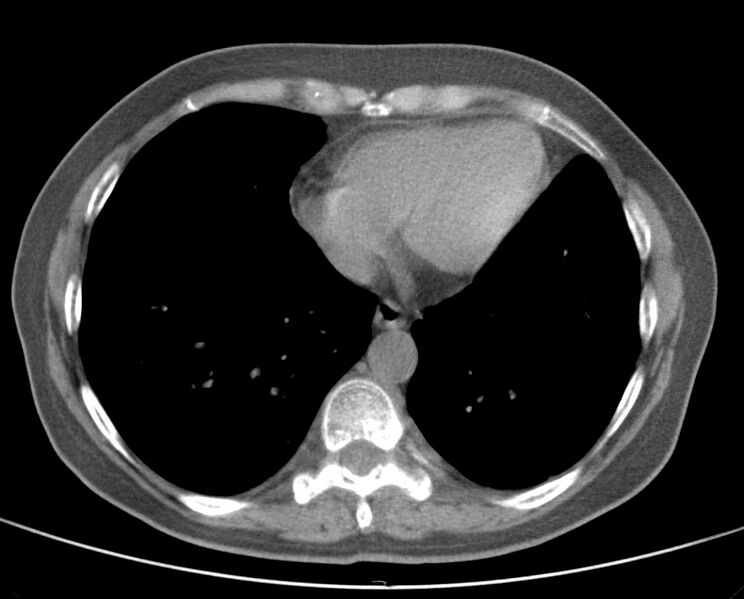 File:Adenosquamous lung carcinoma (Radiopaedia 22035-22030 non-contrast 43).jpg