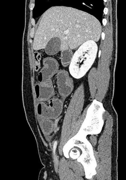 File:Adhesional small bowel obstruction (Radiopaedia 58900-66131 Sagittal C+ portal venous phase 75).jpg