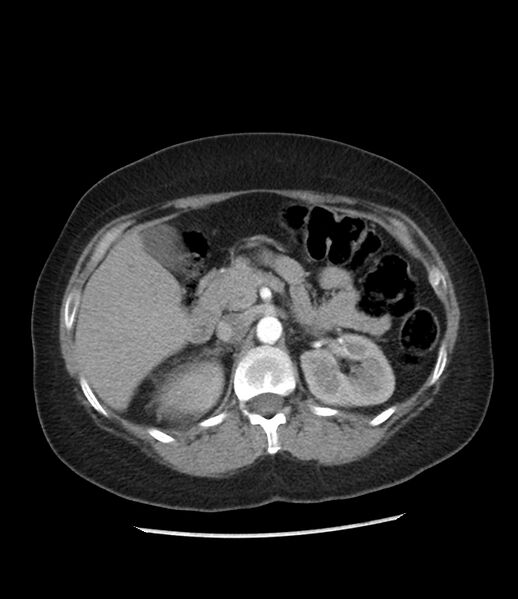 File:Adrenal cortical carcinoma with IVC invasion and thrombosis (Radiopaedia 34307-35597 Axial C+ arterial phase 31).jpg