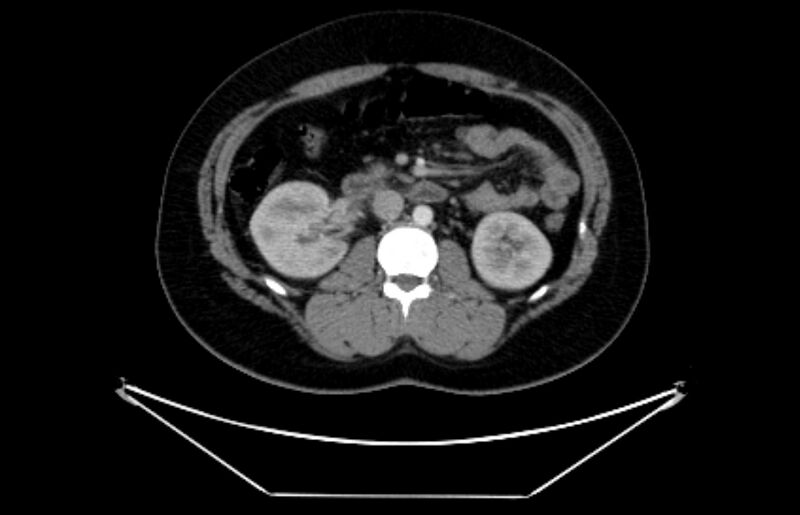 File:Adrenocortical carcinoma (Radiopaedia 80134-93438 Axial C+ portal venous phase 60).jpg