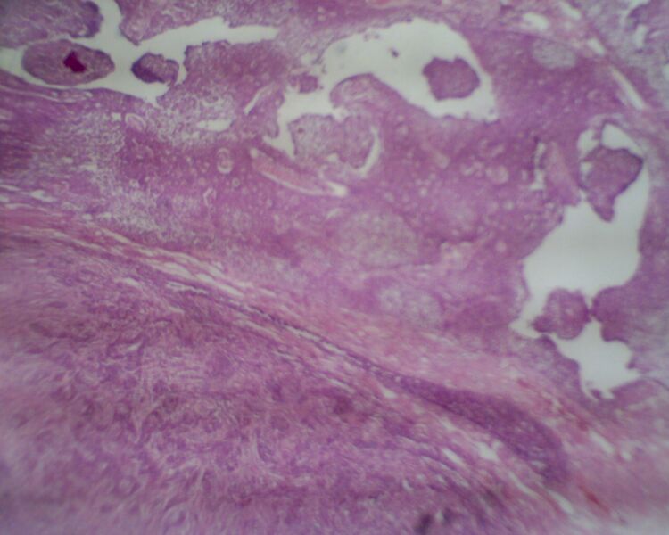 File:Adult granulosa cell tumor of the ovary (Radiopaedia 64991-74394 4x H&E 1).jpg