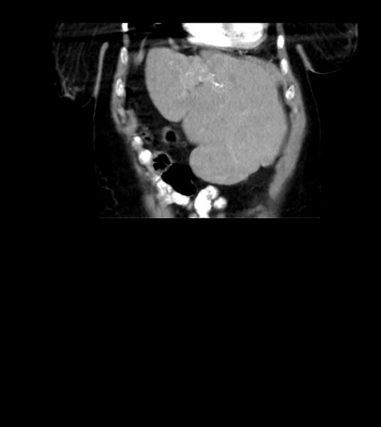 File:Agenesis of the right hepatic lobe (Radiopaedia 78273-90871 D 11).jpg