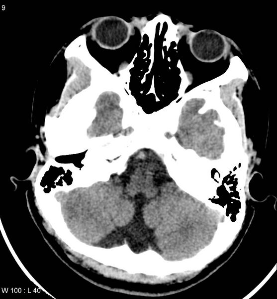 File:Aicardi syndrome (Radiopaedia 5353-7116 Axial non-contrast 6).jpg