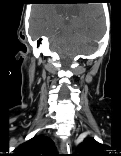 File:Airway narrowing post surgical drainage of neck abscess (Radiopaedia 28885-29206 B 35).jpg