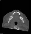 Ameloblastoma (Radiopaedia 18115-17901 Axial bone window 3).jpg