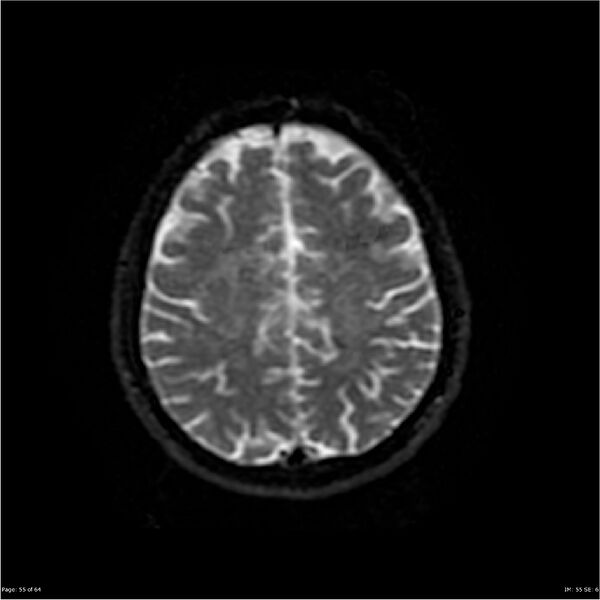File:Amnestic syndrome secondary to hypoxic brain injury (Radiopaedia 24743-25004 DWI 55).jpg