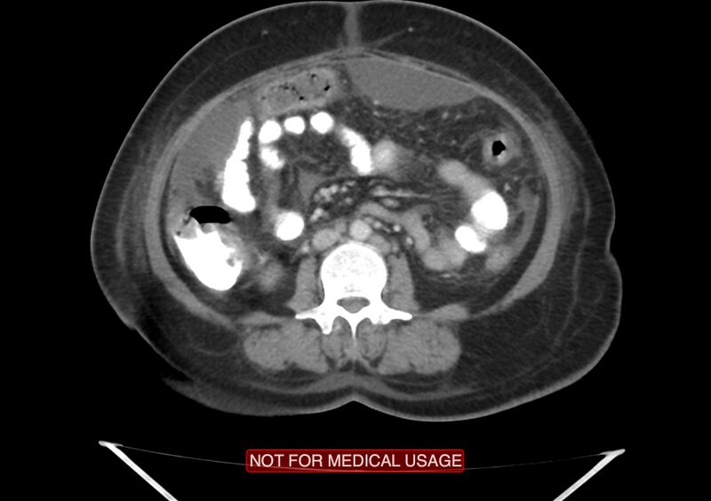 File:Amoebic enterocolitis with liver abscess (Radiopaedia 35100-36609 A 44).jpg