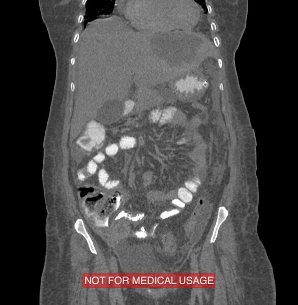 File:Amoebic enterocolitis with liver abscess (Radiopaedia 35100-36609 B 63).jpg