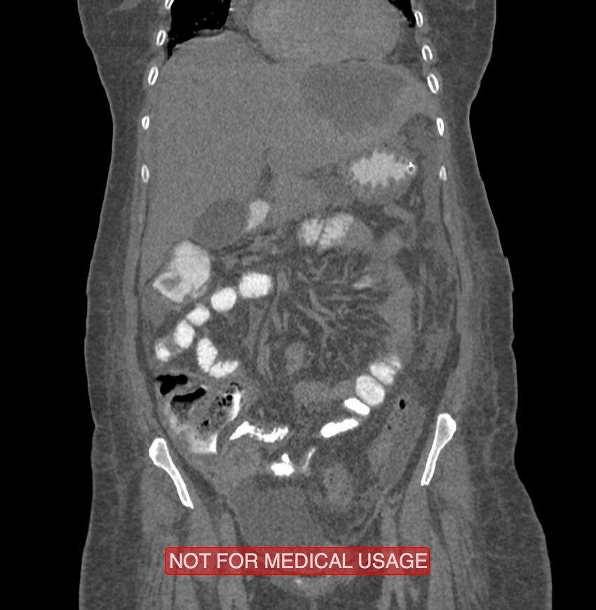 Amoebic enterocolitis with liver abscess (Radiopaedia 35100-36609 B 63).jpg