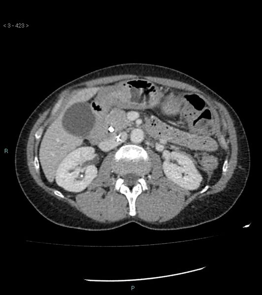 File:Ampulla of Vater metastasis (Radiopaedia 27820-28069 A 61).jpg