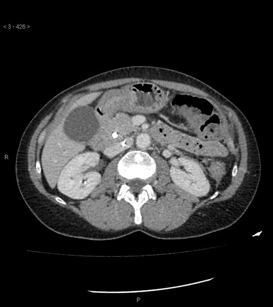 File:Ampulla of Vater metastasis (Radiopaedia 27820-28069 A 64).jpg