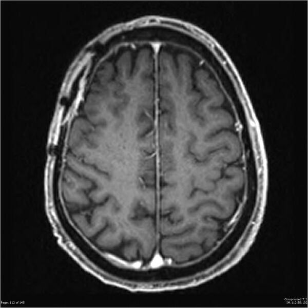 File:Anaplastic meningioma with recurrence (Radiopaedia 34452-35788 Axial T1 C+ 112).jpg