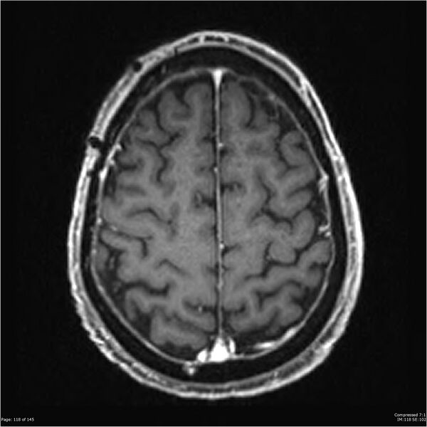 File:Anaplastic meningioma with recurrence (Radiopaedia 34452-35788 Axial T1 C+ 118).jpg