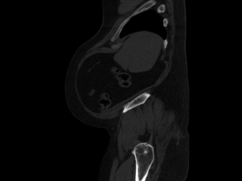 Ankylosing spondylitis (Radiopaedia 44609-48357 Sagittal bone window 103).jpg