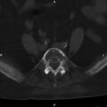Ankylosing spondylitis (Radiopaedia 8748-9556 Axial bone window 44).jpg