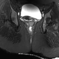 Ano-vaginal fistula (Radiopaedia 29765-30284 Coronal STIR 14).jpg