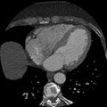 Anomalous origin of left circumflex artery from right coronary sinus (Radiopaedia 72563-83117 B 107).jpg