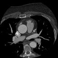 Anomalous origin of left circumflex artery from right coronary sinus (Radiopaedia 72563-83117 B 20).jpg