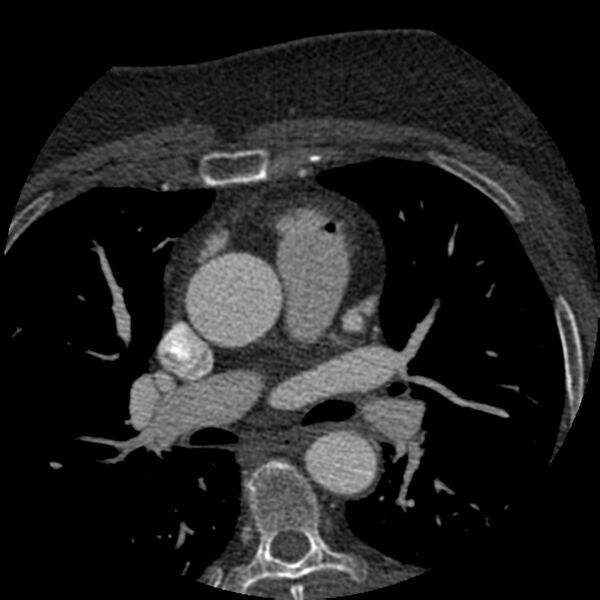 File:Anomalous origin of left circumflex artery from right coronary sinus (Radiopaedia 72563-83117 B 20).jpg