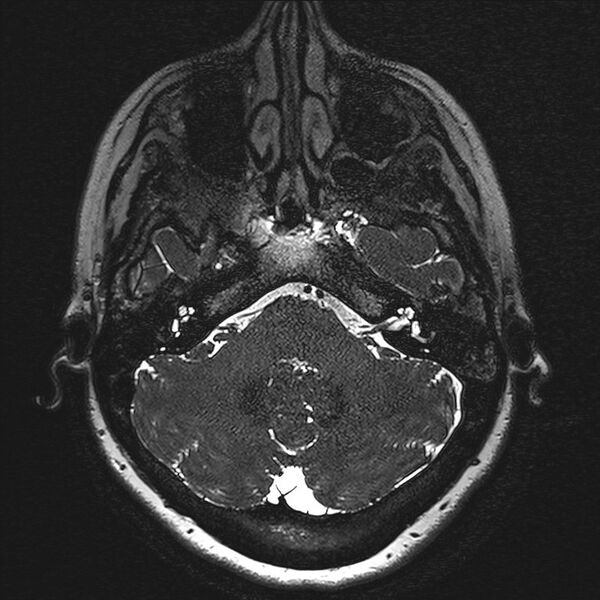 File:Anterior temporal encephalocele (Radiopaedia 82624-96808 Axial T2 high res 8).jpg