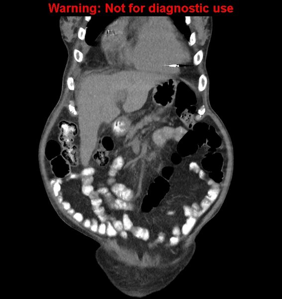 File:Aortic graft infection (Radiopaedia 44979-48907 non-contrast 13).jpg