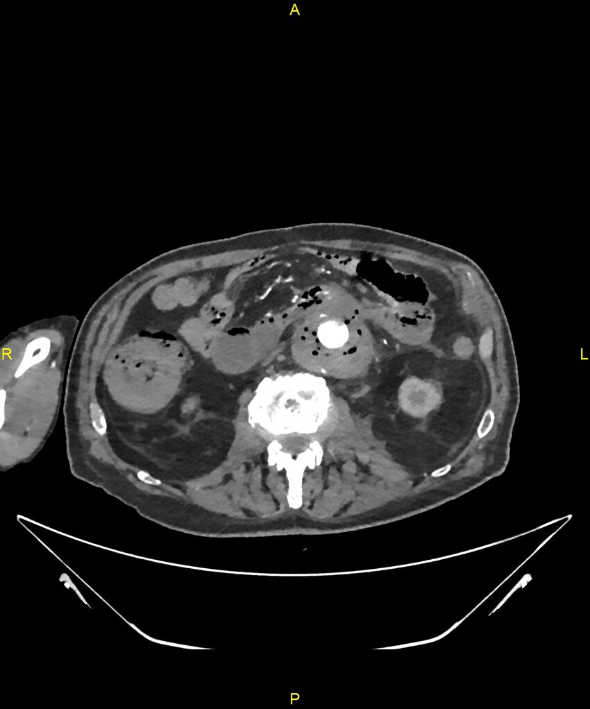 Aortoenteric fistula (Radiopaedia 84308-99603 B 166).jpg