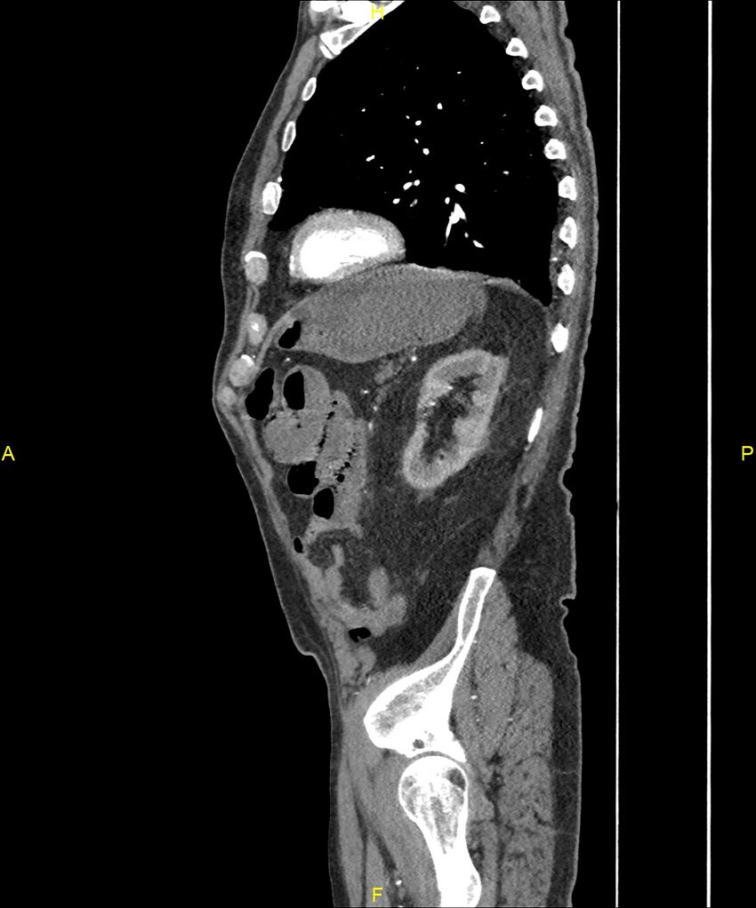 Aortoenteric fistula (Radiopaedia 84308-99603 C 259).jpg