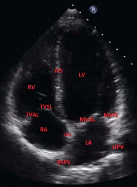 File:Apical 4 chamber view - normal (transthoracic echocardiography) (Radiopaedia 62756).jpg