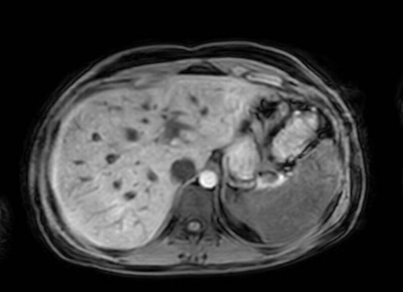 File:Appendicitis in gravida (MRI) (Radiopaedia 89433-106395 Axial DIXON 20).jpg