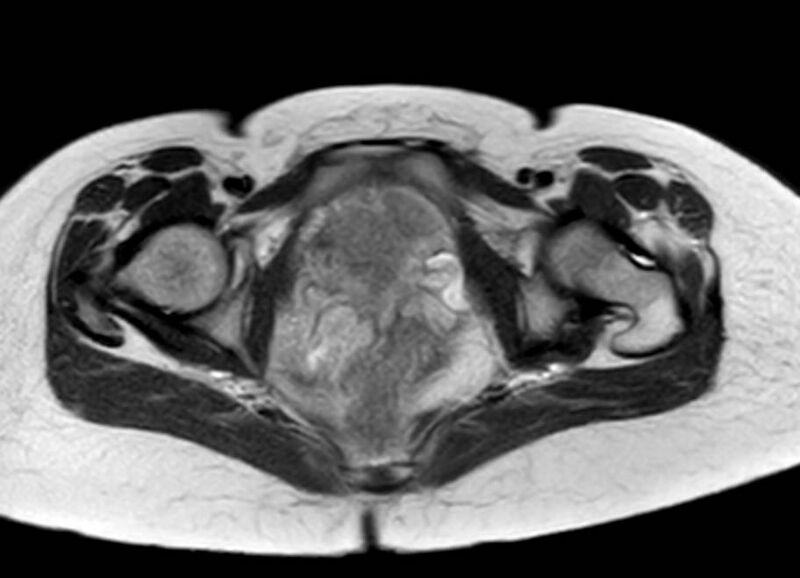 File:Appendicitis in gravida (MRI) (Radiopaedia 89433-106395 Axial T2 68).jpg