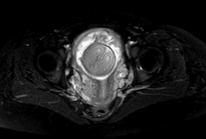 Appendicitis in gravida (MRI) (Radiopaedia 89433-106395 Axial T2 SPAIR 69).jpg