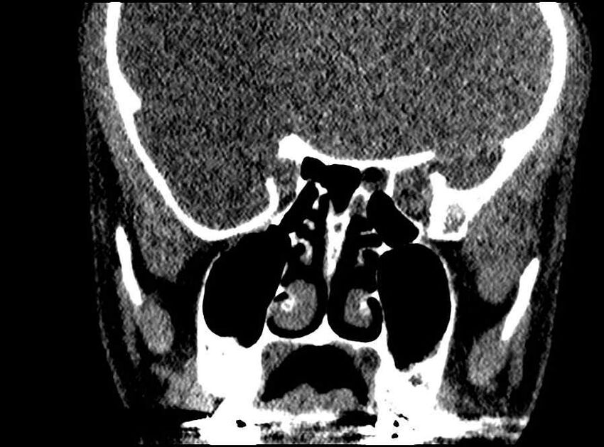 Arachnoid cyst- extremely large (Radiopaedia 68741-78450 Coronal bone window 36).jpg