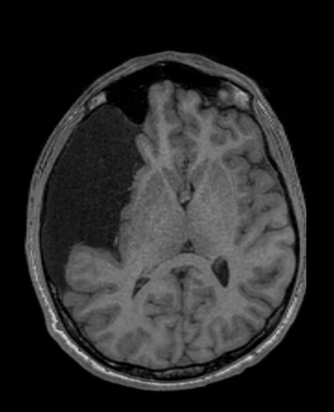 File:Arachnoid cyst- extremely large (Radiopaedia 68741-78451 Axial T1 40).jpg