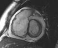 Arrhythmogenic right ventricular cardiomyopathy (Radiopaedia 69431-79307 Short axis cine 177).jpg